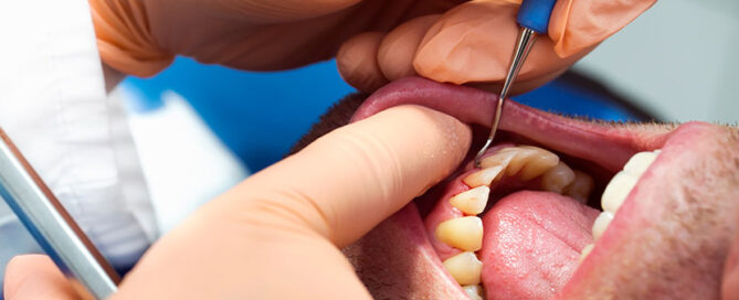 Periodontal Gum Disease