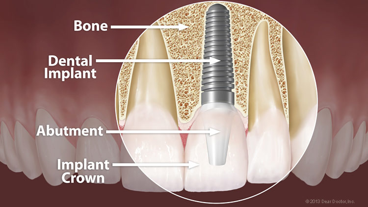 Dental Implant Anatomy Large
