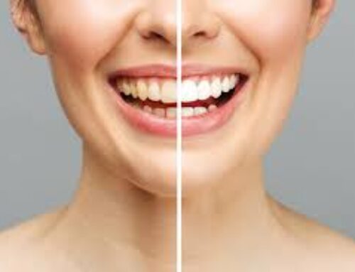 Is Teeth Whitening Safe?