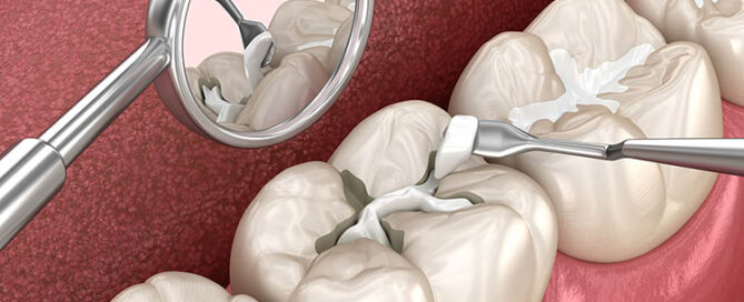 Dental sealants